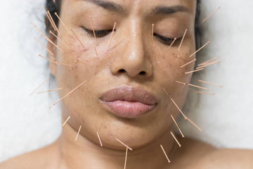 You Won’t Believe What Tiny Needles Can Do for Your Skin